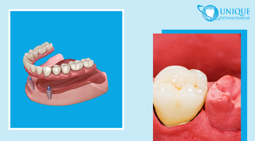 maxillary-prosthesis-with-gum-all-on-2-system-supported-by-implants-and-close-up-of-a-tooth