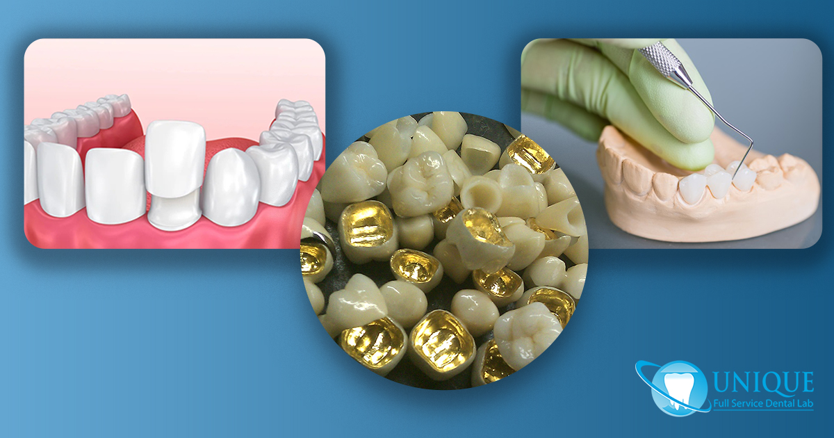 dental-bridge-making-process-in-cast-3d-veneer-placement-and-cast-gold-restoration