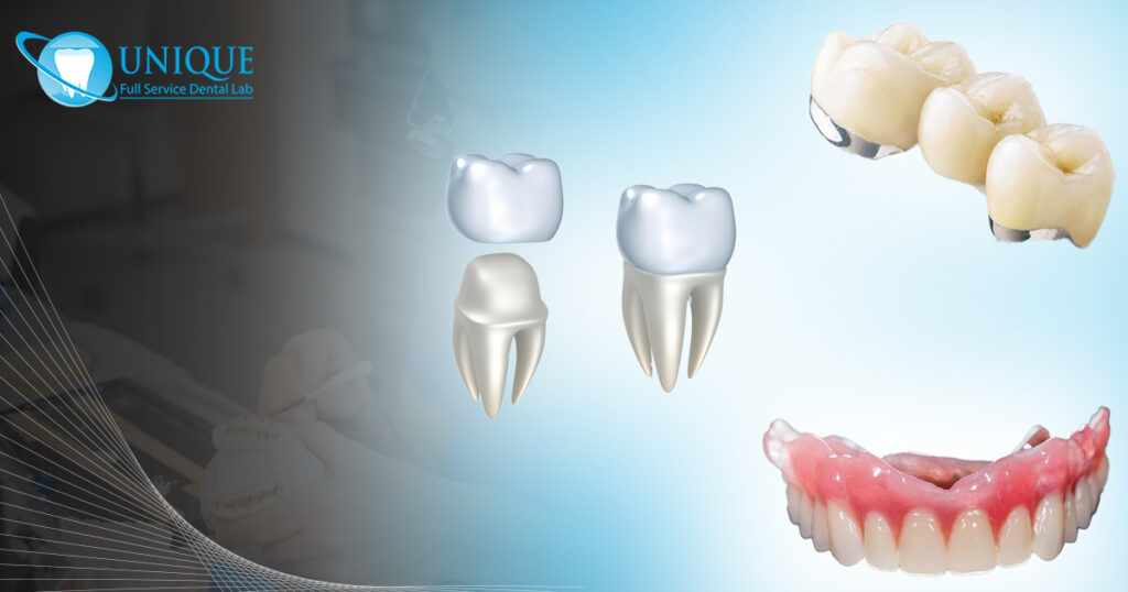 Quality Levels and Costs of a porcelain fused to metal crown