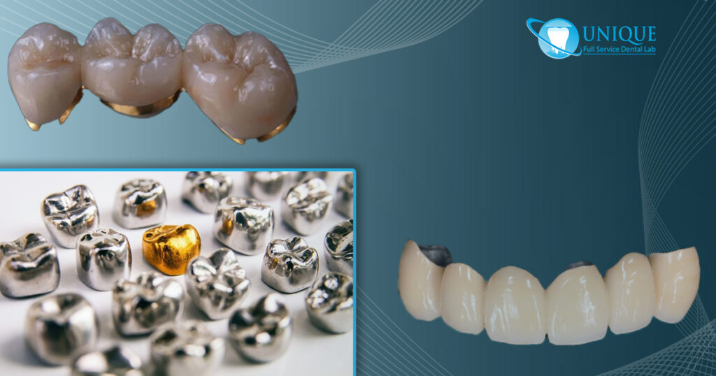 Quality Levels and Costs of a porcelain fused to metal crown