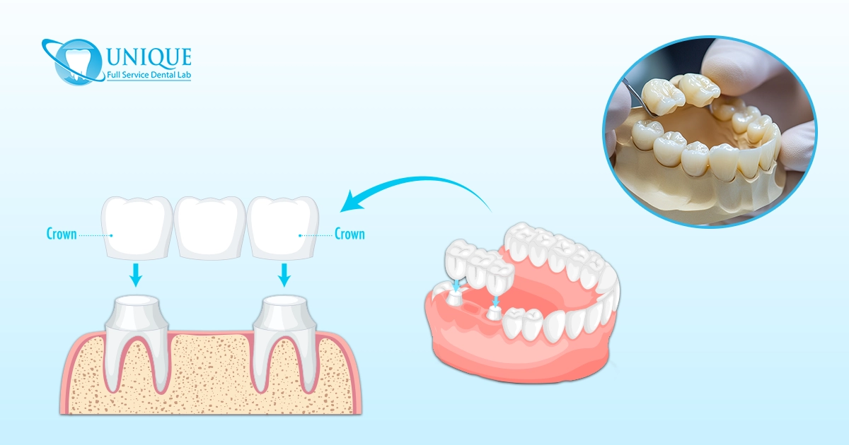 Diagram illustrating the process of getting a dental bridge, showing two adjacent teeth prepped with dental crowns to support a prosthetic tooth, and a model of a dental bridge being placed.